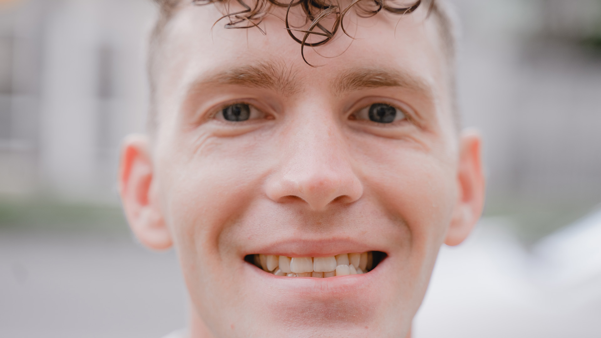 crooked front teeth solutions Singapore