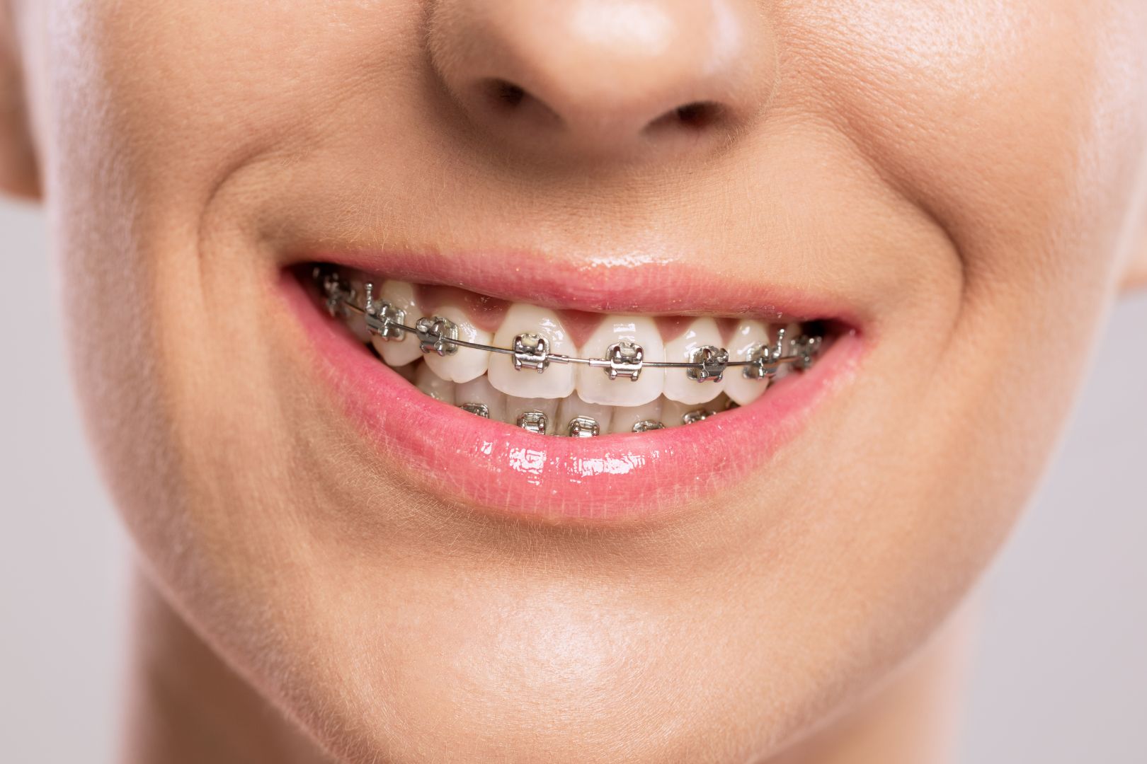 metal braces in Singapore