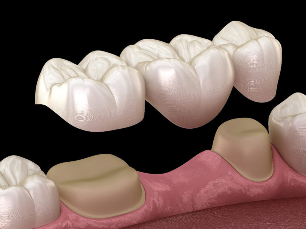 tooth bridge procedure