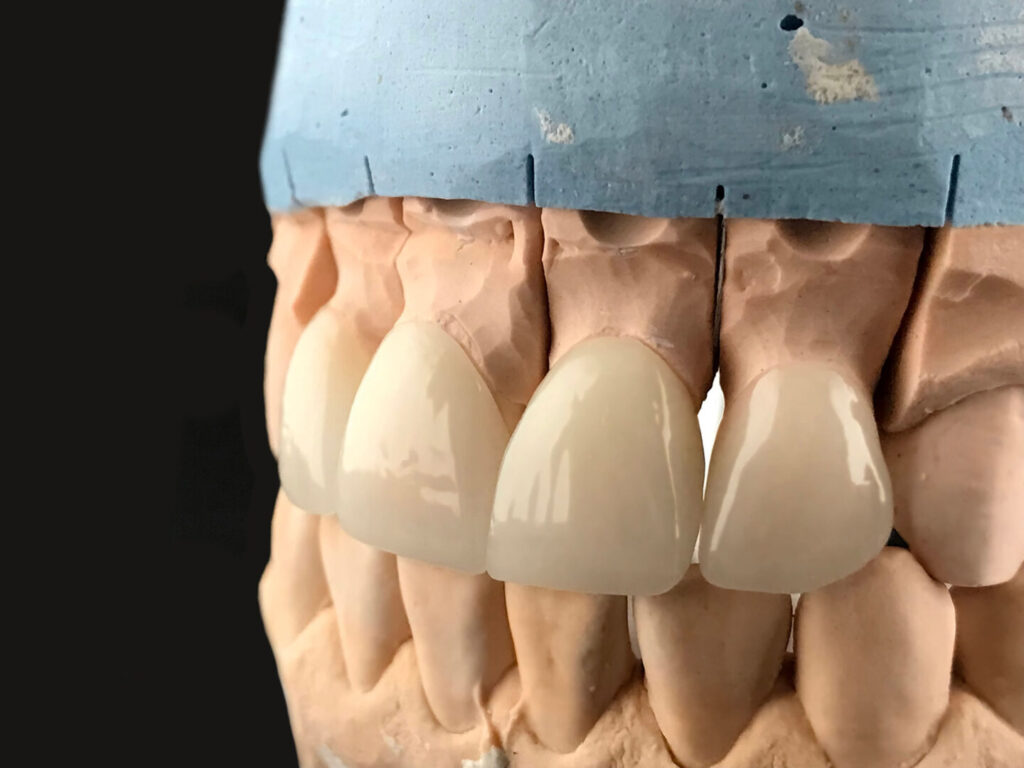 composite veneers vs porcelain veneers