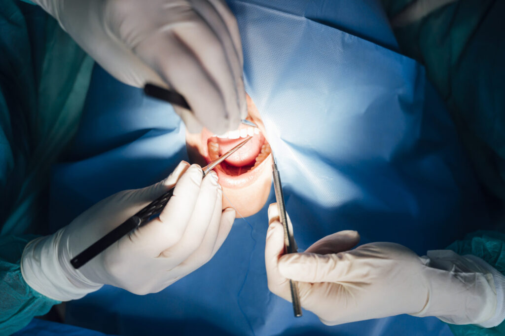 extraction of wisdom tooth