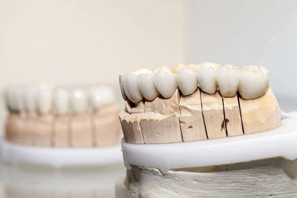 porcelain veneers pros and cons