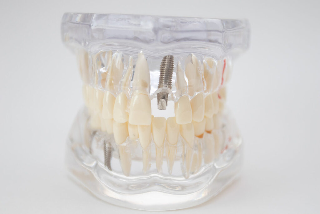 Singapore dental implant centre