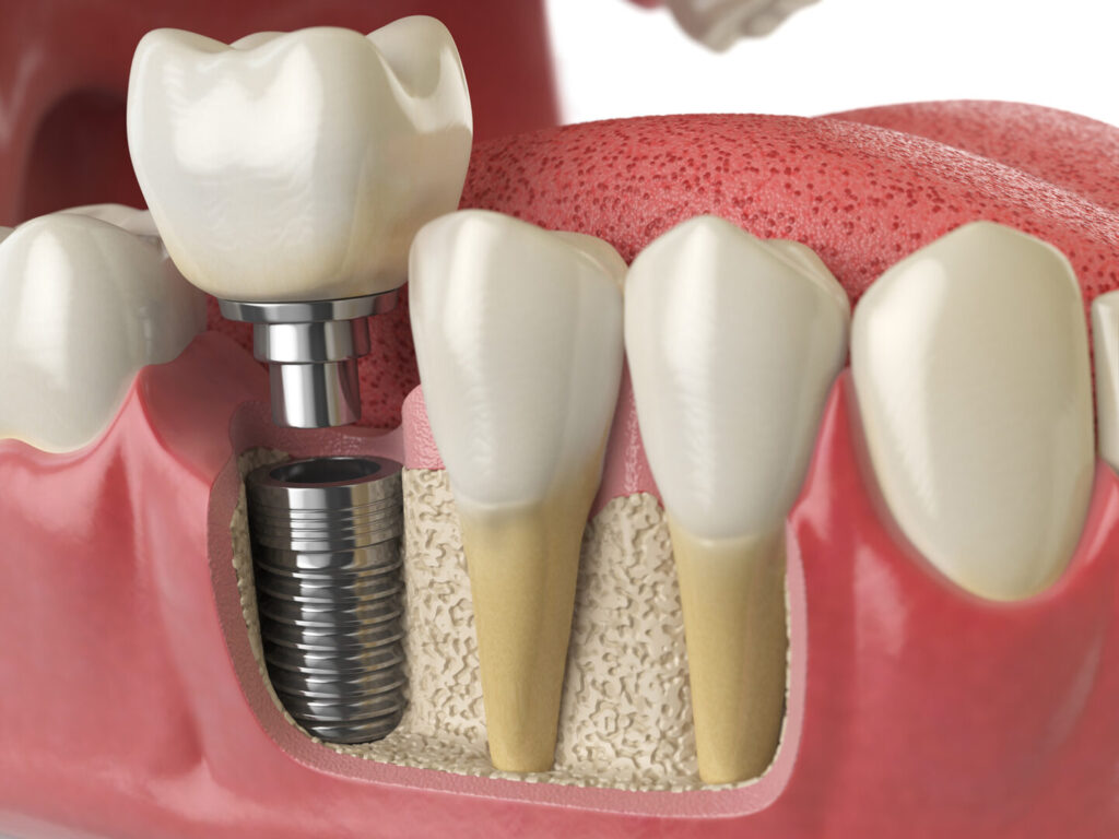 dental implant cost Singapore