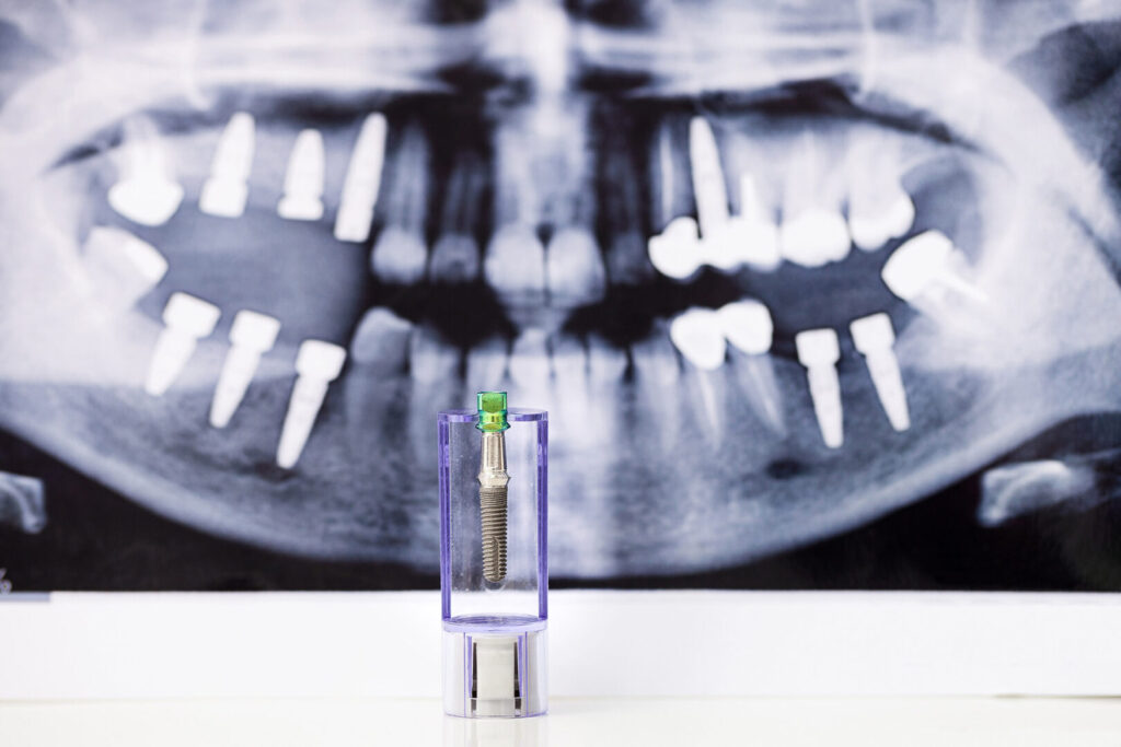 dental implant x-ray