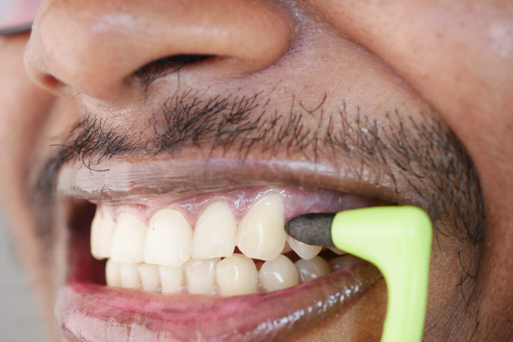 bonding treatment for teeth