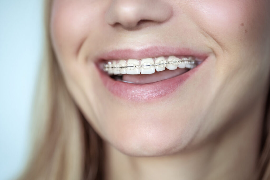 clear ceramic braces