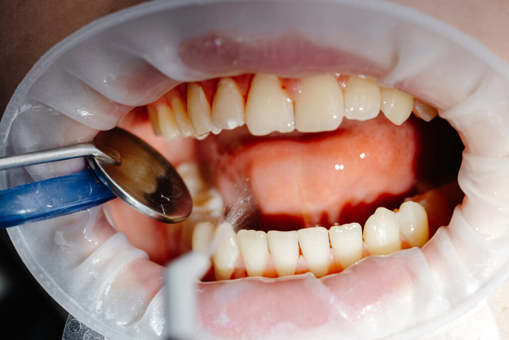 periodontal disease treatment cost