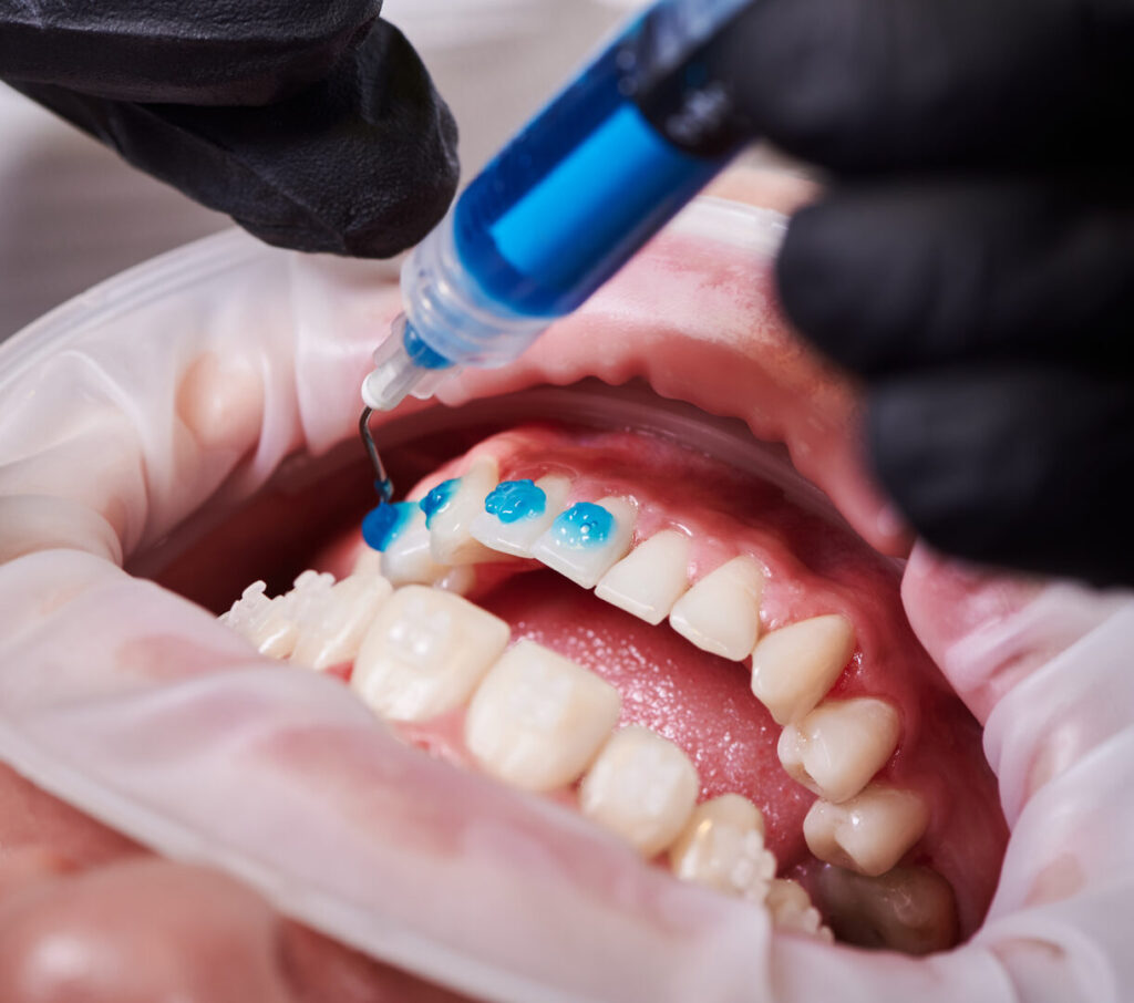 gingival recession