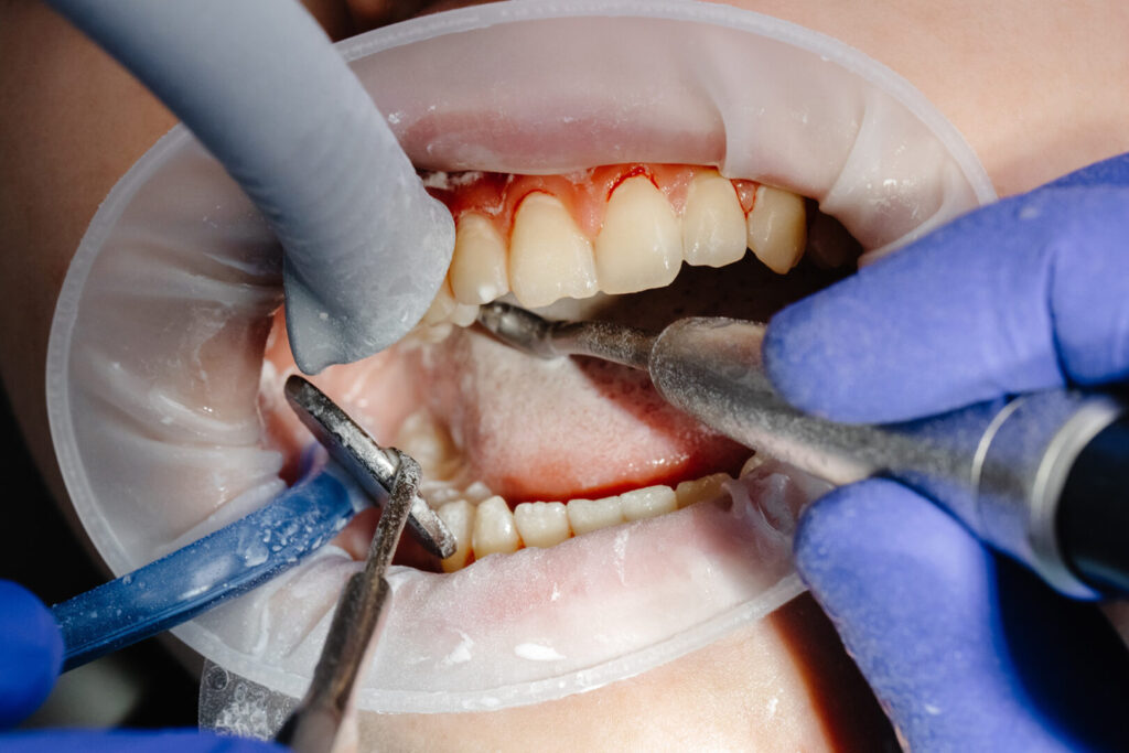 new gingival recession treatment